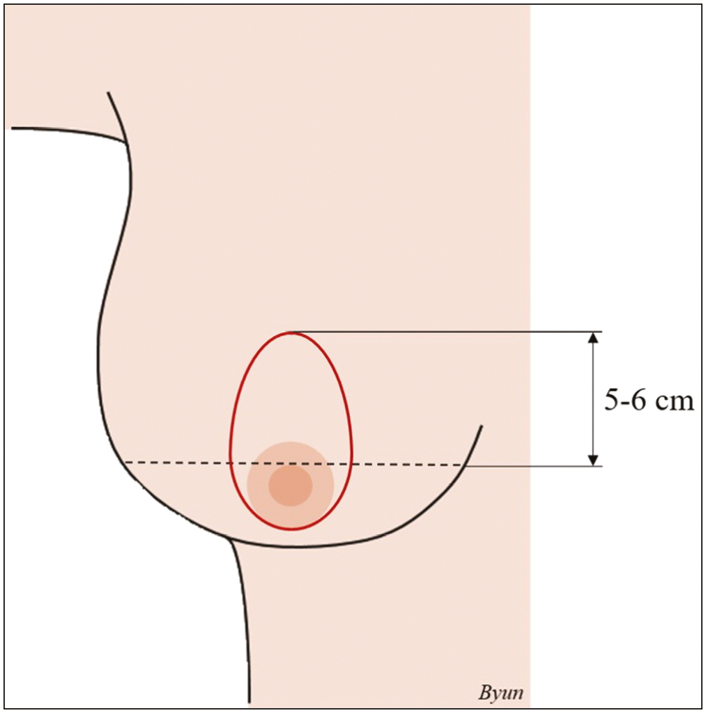 Surgical design of periareolar augmentation mastopexy. The upper margin of the relocated areola is 5–6 cm above the inframammary fold