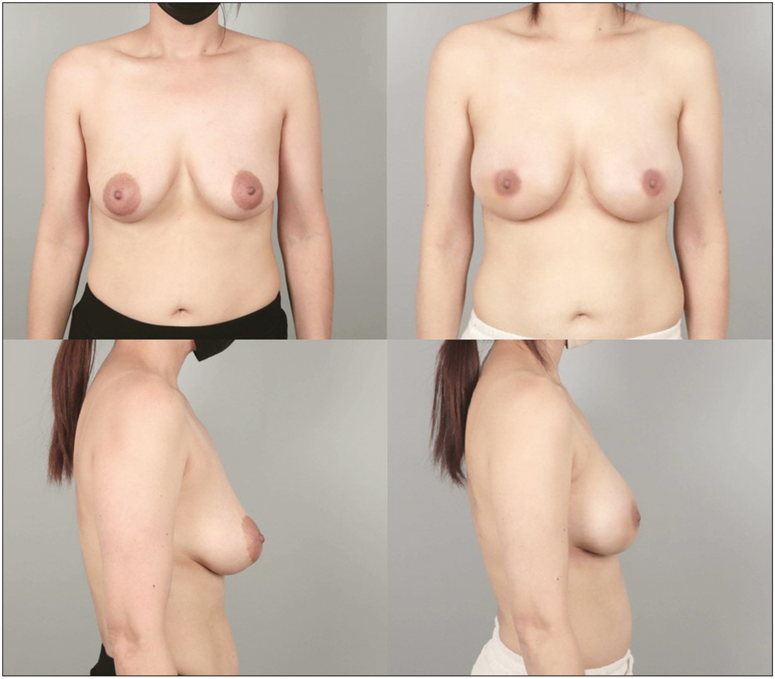 Preoperative front and lateral views (left above and below) and postoperative front and lateral views (right above and below) of a 46-year-old female who received periareolar augmentation mastopexy with 295 cc implants