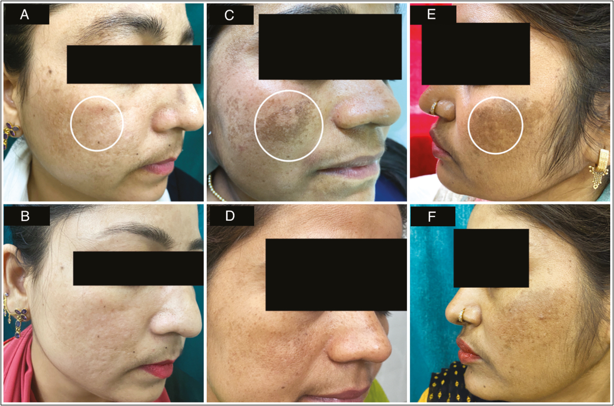 (A) Skin appearance at baseline in a mild case of melasma showing area of dermoscopic marking in white circle. (B) Skin appearance at end of 12 weeks post treatment in a mild case of melasma (C) Skin appearance at baseline in a moderate case of melasma showing area of dermoscopic marking in white circle. (D) Skin appearance at end of 12 weeks post treatment in a moderate case of melasma. (E) Skin appearance at baseline in a severe case of melasma showing area of dermoscopic marking in white circle. (F) Skin appearance at end of 12 weeks post treatment in a severe case of melasma