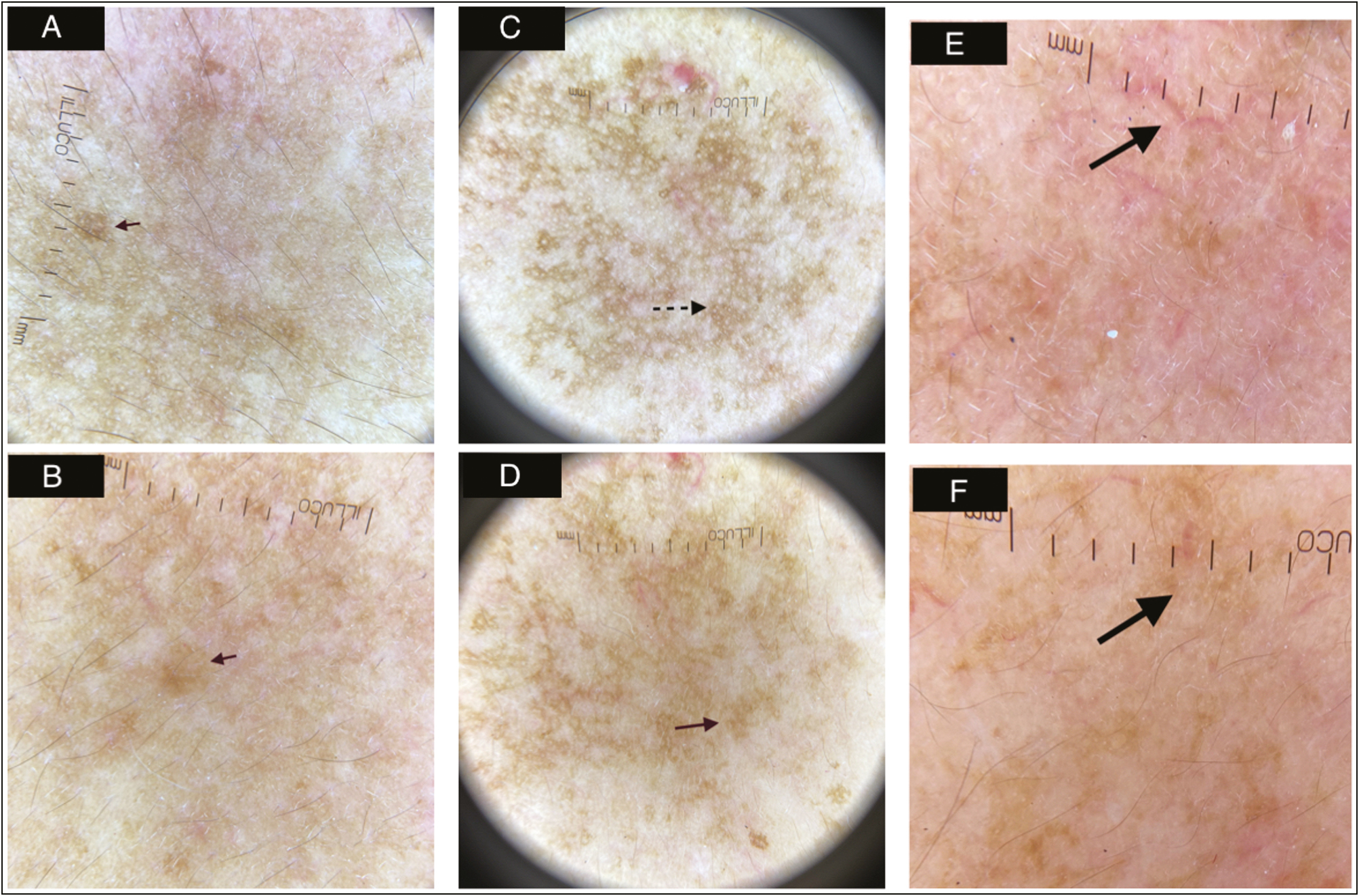 (A) Skin appearance at baseline in a moderate case of melasma showing area of dermoscopic marking in white circle. (B) Skin appearance at end of 12 weeks posttreatment in a moderate case of melasma (C) Dermoscopy (X10, ILLUCO,Korea) at baseline showing dots and globules marked by black dotted arrow. (D) Dermoscopy (X10, ILLUCO,Korea)after 12 weeks of treatment showing resolution of dots and globules marked by red solid arrow. (E) Dermoscopy (X10, ILLUCO,Korea) at baseline showing telengiectasias marked by black solid arrow. (F) Dermoscopy (X10, ILLUCO,Korea) after 12 weeks of treatment showing resolution of telengiectasias marked by black solid arrow