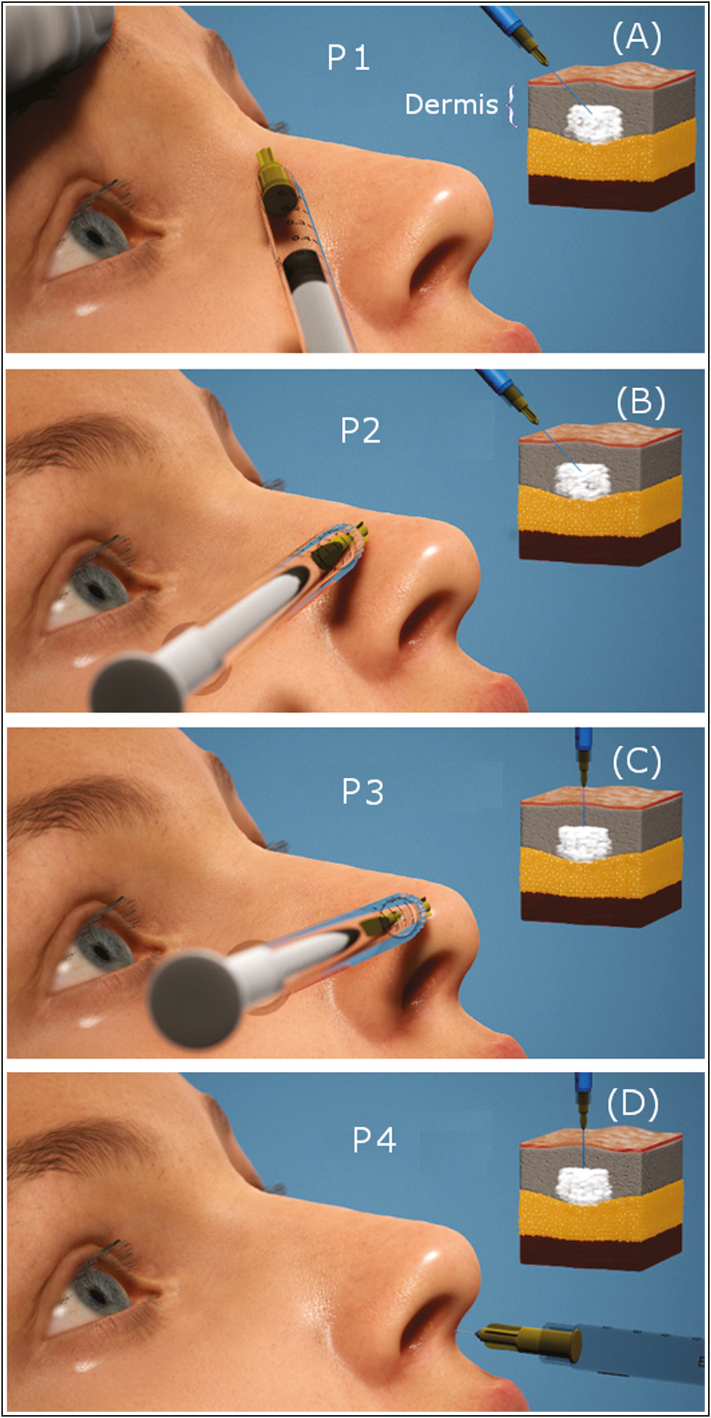 Main points, namely nasion (P1), nasal dorsum (P2), nasal tip (P3), and subnasal (P4) used in the injection technique and corresponding dermis plane where the injection is carried out