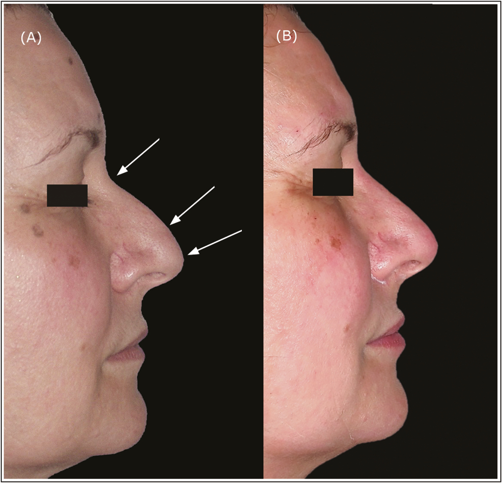 A 52-year-old woman. Lateral view of hook nose (A) before and (B) immediately after injection of 0.2 cc of HA in P1, 0.1 cc in P2, and 0.25 cc in P3. After filler reshaping the hook nasal profile has improved