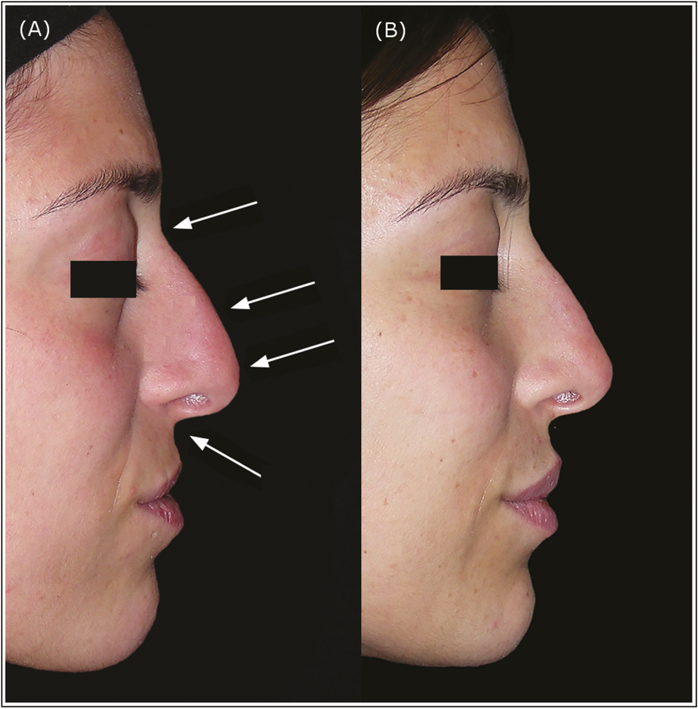 A 29-year-old woman. Lateral view of hook nose (A) before and (B) 6 months after injection of 0.15 cc of HA in P1, 0.1 cc in P2, 0.20 cc in P3, and 0.1 cc in P4. After filler injections the nasal profile has improved. Also the upper lip has been corrected