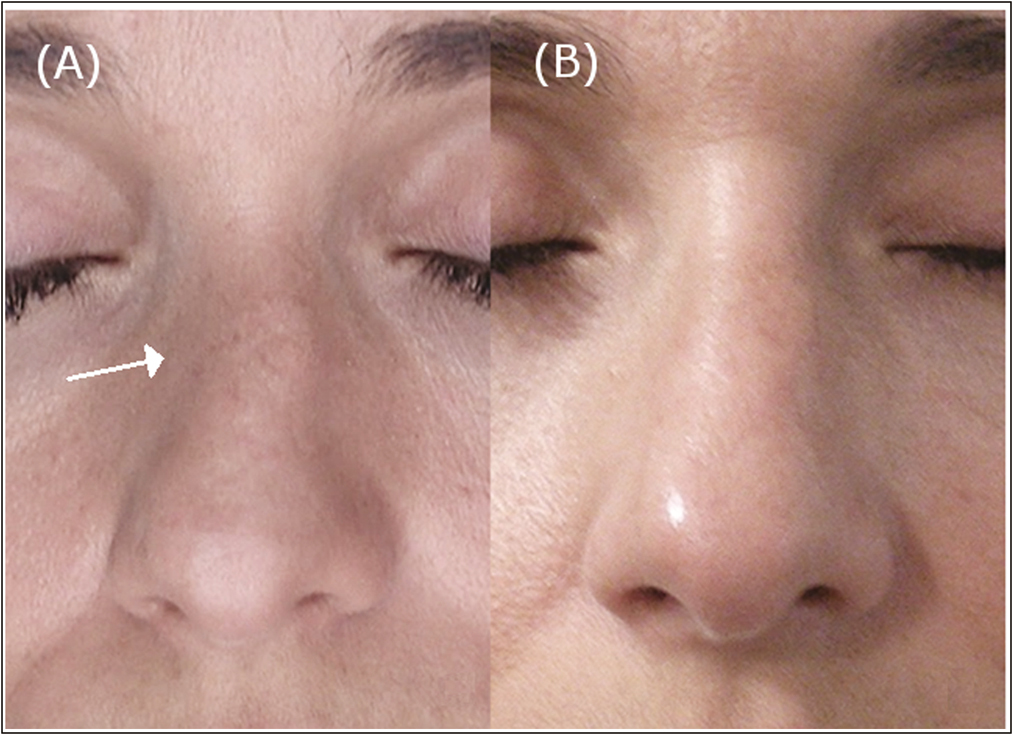 A 40-year-old woman. Frontal view of (A) pre-operative and (B) post-operative situation 6 months after injecting 0.4 cc of HA in P2 in the right side and 0.1 cc of HA in P2 in the left side . The nasal axial deviation has been improved