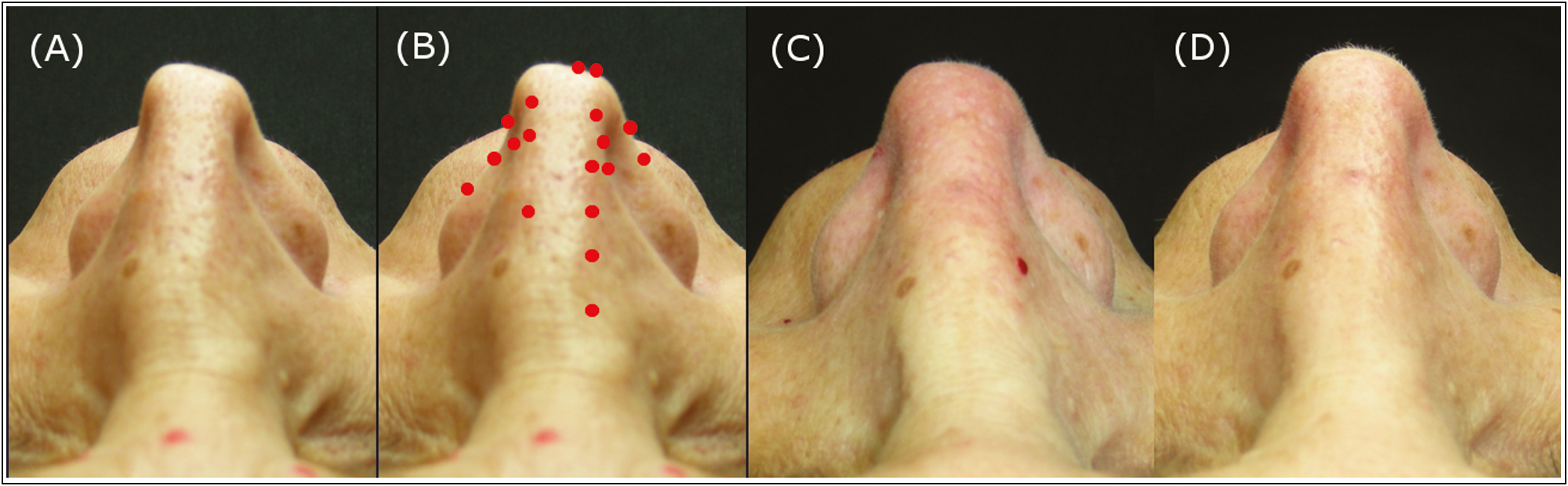 A 51-year-old woman. Above view of pre-operative situation (25 years after surgical rhinoplasty (A), injection points (B), immediately after injection (C) and post-operative situation 6 months after injecting 0.6 cc of HA in total. There is an improvement of the pinched tip due to the previous rhinoplasty and a reshaping of the alar rim