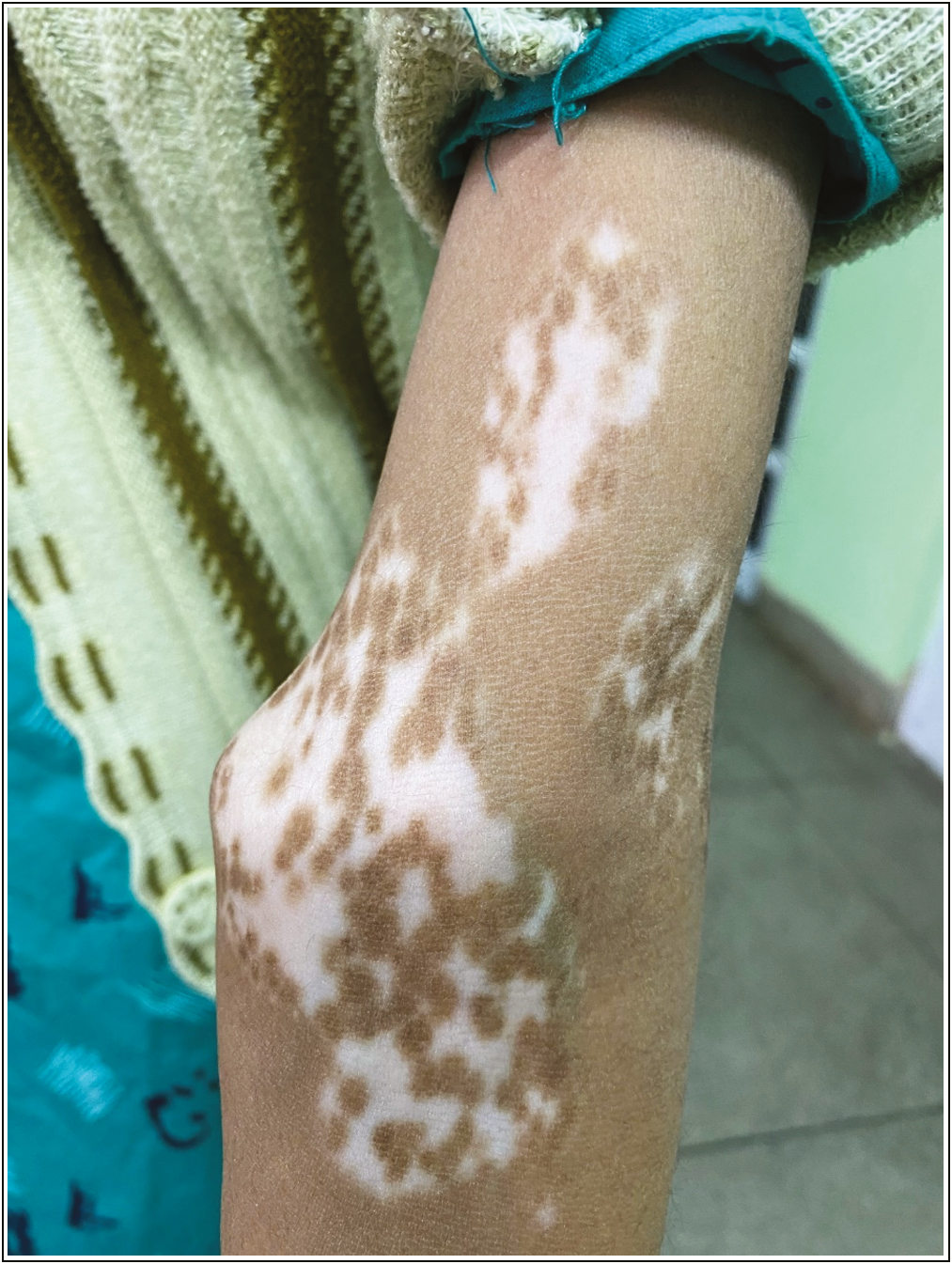 Stable vitiligo patch on the right elbow and lower part of arm prepared for JT (preprocedure)