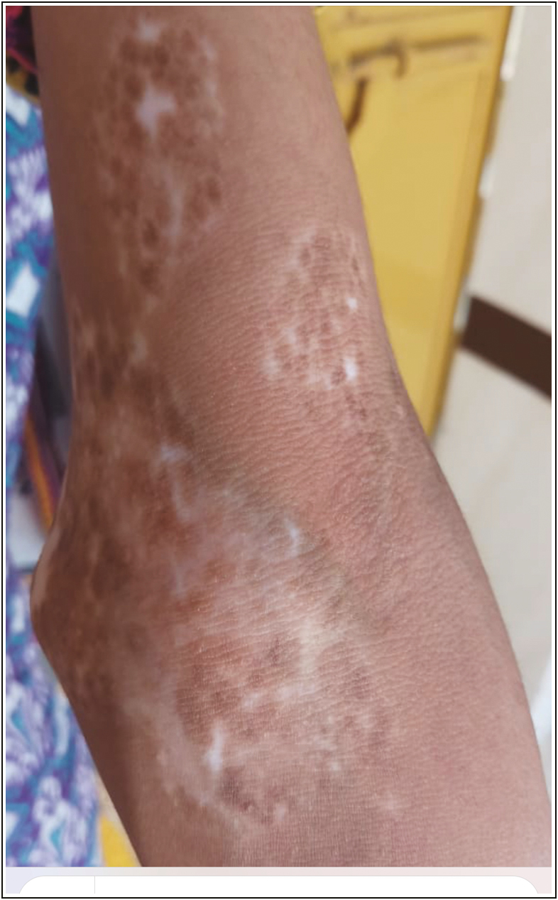 Stable vitiligo patch on the right elbow and lower part of arm showed >75% repigmentation after JT at 16 weeks (post-procedure)