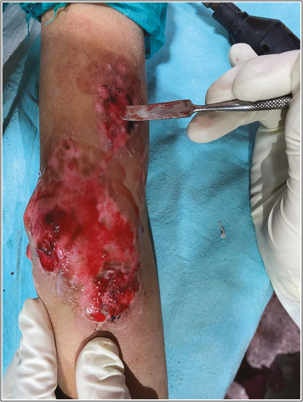 Vitiligo patch showing paste-like material covering the site in JT (during procedure)