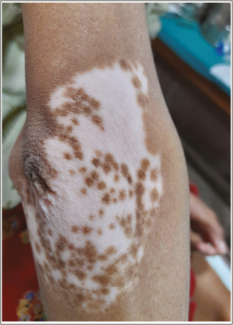 Stable vitiligo patch on elbow of right arm preparing for NCES (preprocedure)