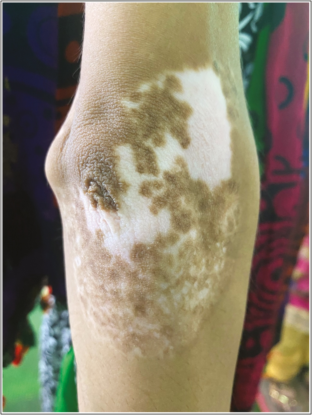 Stable vitiligo patch showed >70% repigmentation after NCES at 16 weeks (post-procedure)