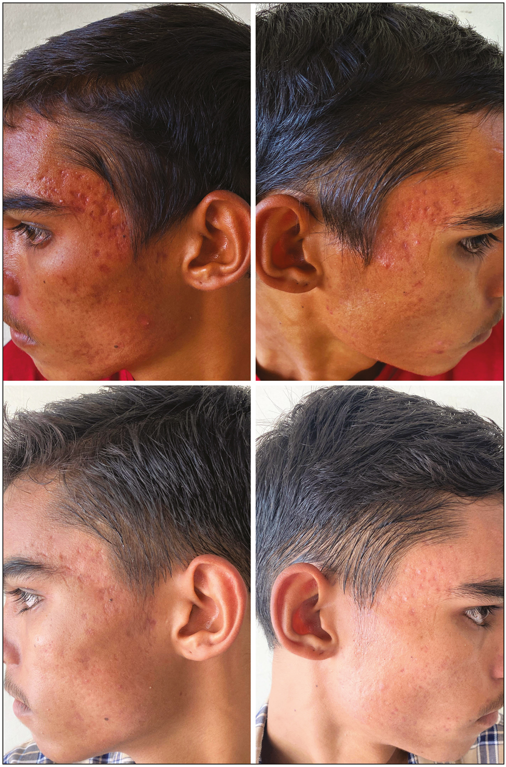 Photograph of a 23-year-old patient in Group A showing improvement after four sessions of Er:YAG laser