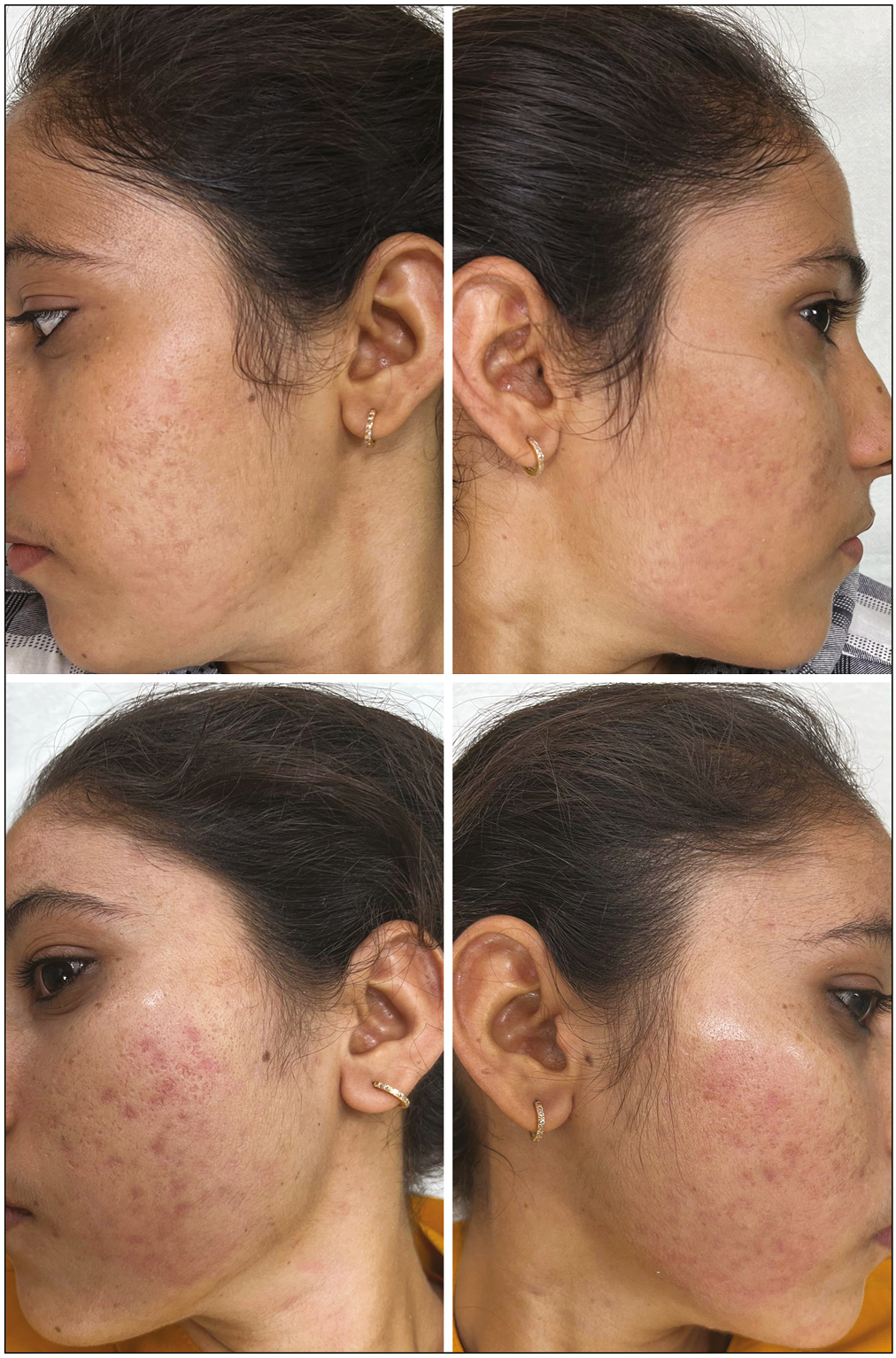 Photograph of a 21-year-old patient in Group B showing improvement after four sessions of 20% TCA peel