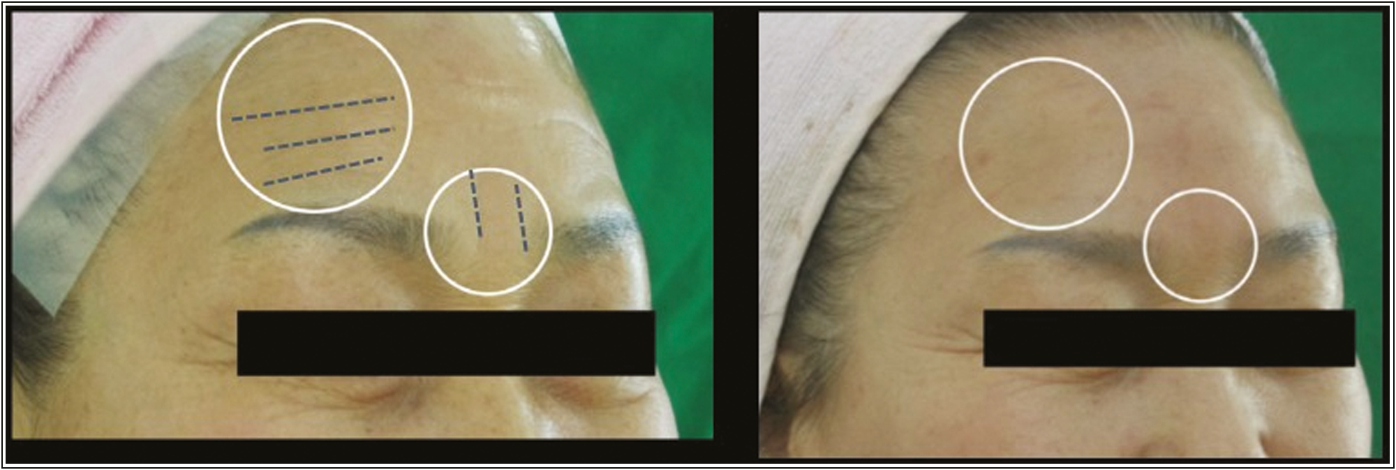 Configuration suggested polydioxanone threads into deep static wrinkles on the upper third. Source: Kang et al.[8]