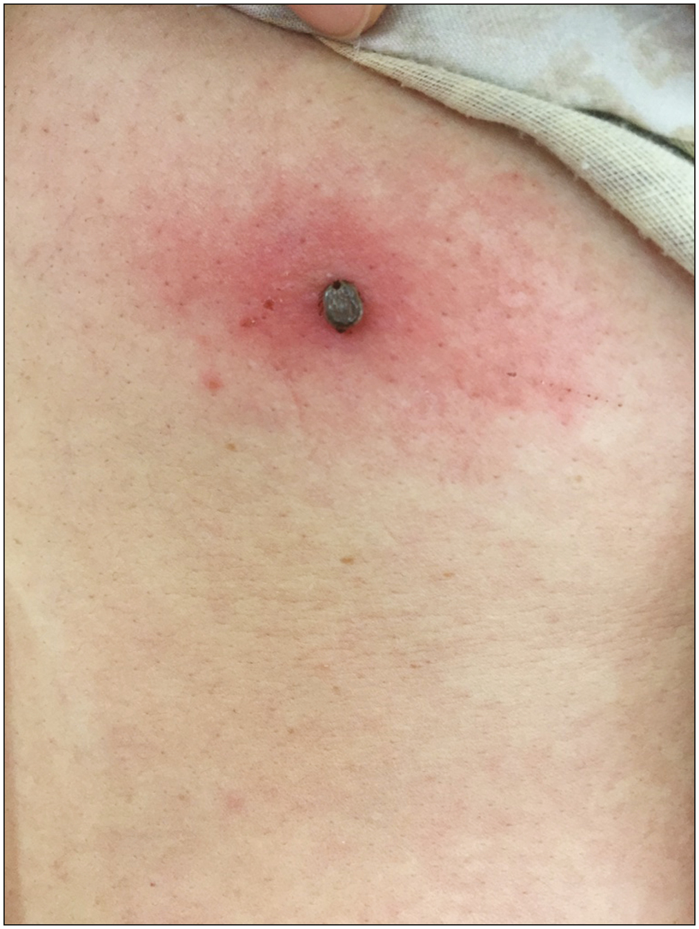 Clinical image of insect bite on the back