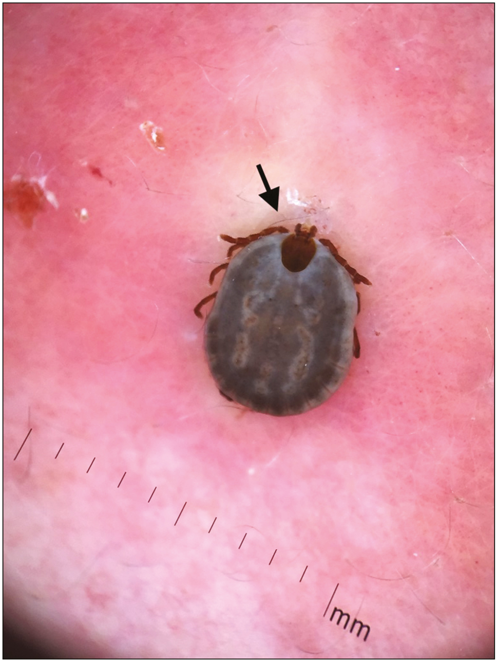 Dermoscopy showing the blackish gray back of the tick with four pairs of dark brown legs on either side and dark mouth piece (black arrow) (polarized mode, DermLite DL3, 10×)