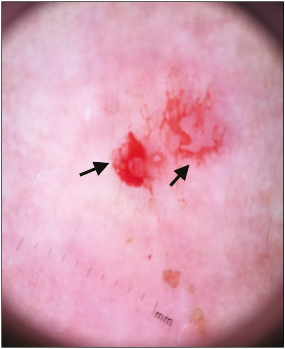 Dermoscopy revealing blood spots and hemorrhagic areas (black arrows) with no remnants after removal of the tick (polarized mode, DermLite DL3, 10×)