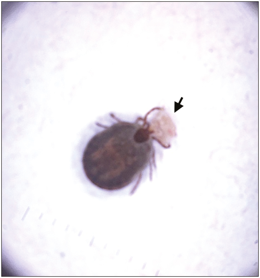 Ex-vivo dermoscopy showing the tick with intact mouth piece on a brownish white scale (black arrow) (polarized mode, DermLite DL3, 10×)