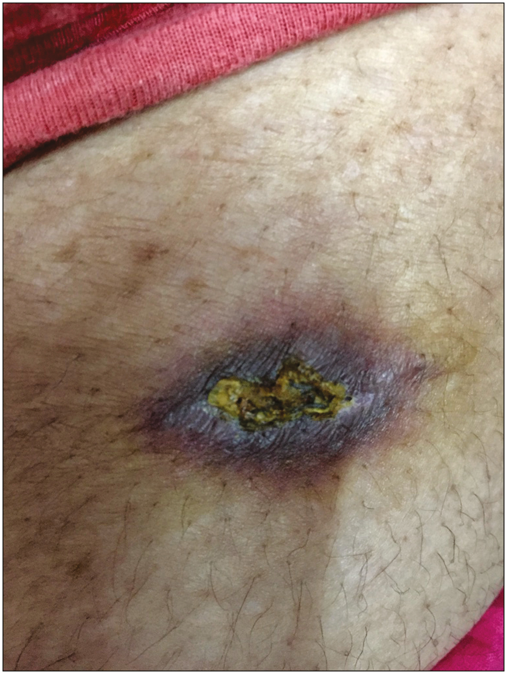 Clinical image of non-healing ulcer on the back