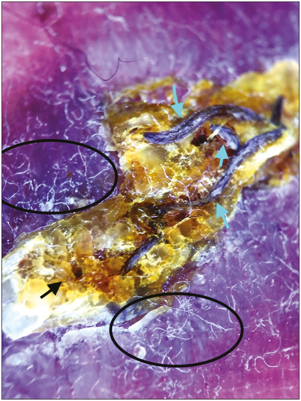 Dermoscopy showing blackish suture material (green arrows) embedded in the brownish yellow homogeneous crust (black arrow), with surrounding adherent fibers (black circles) (polarized mode, DermLite DL3, 10×)