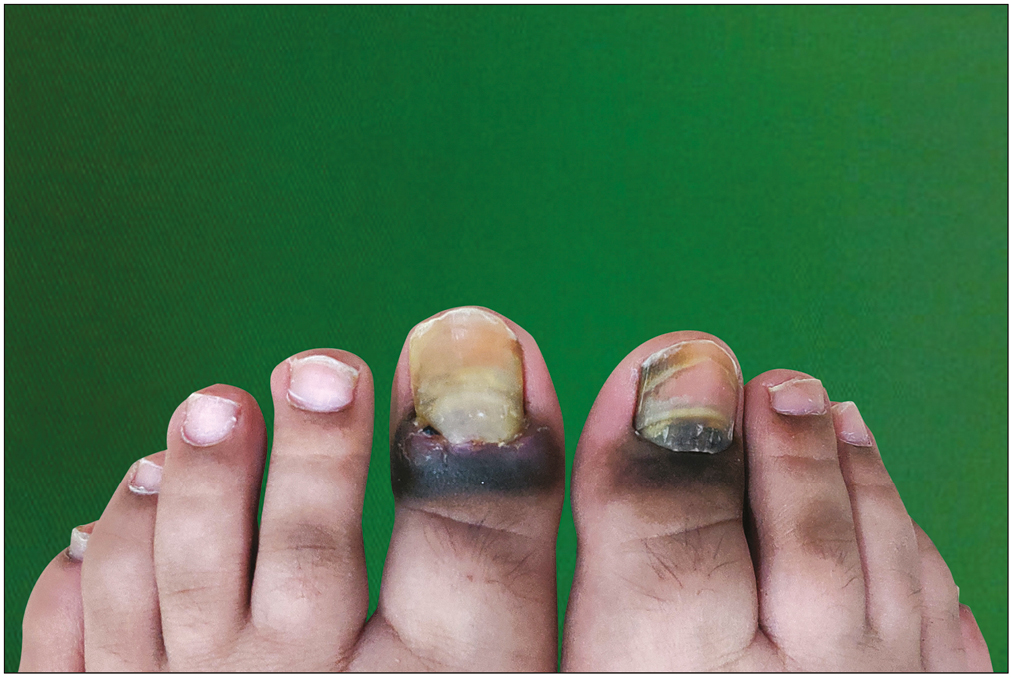 Chronic paronychia, proximal nail fold pigmentation, and yellow-to-black discoloration of nail plate on both halluces