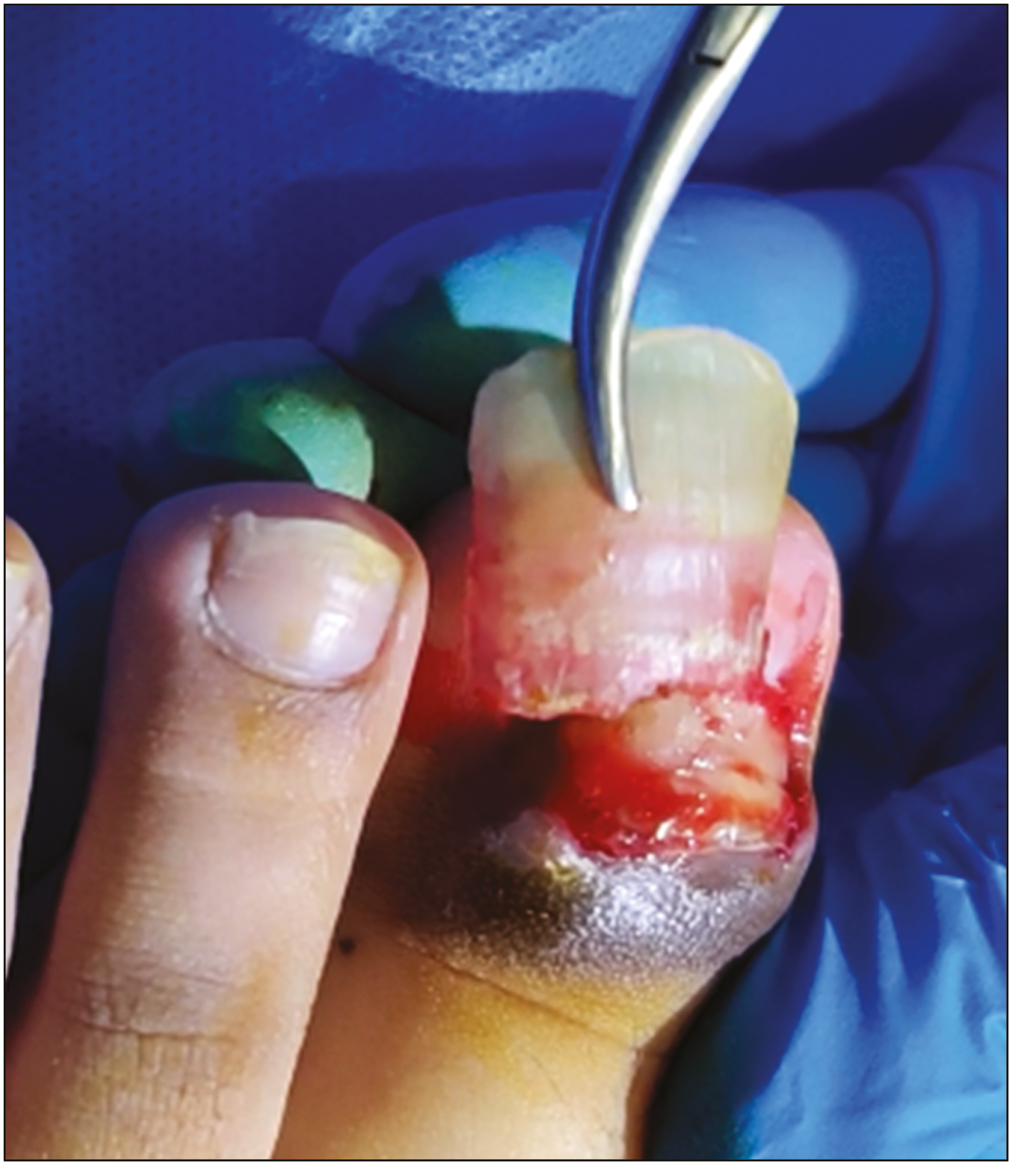 Nail avulsion of left hallux