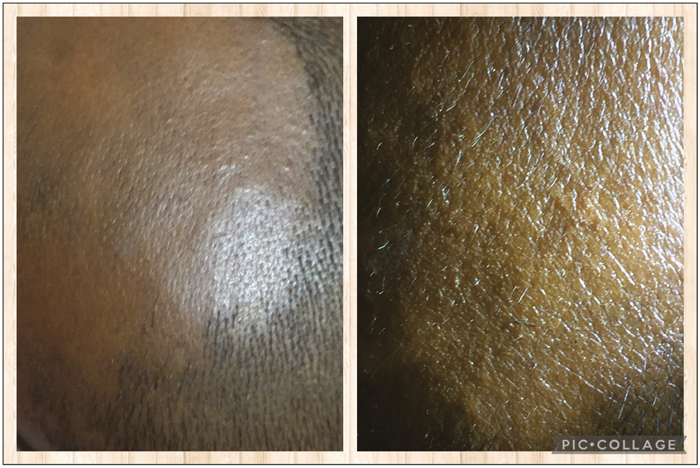 Scalp surface and fine hair grown of alopecia areata of scalp hair in room and tangential lighting