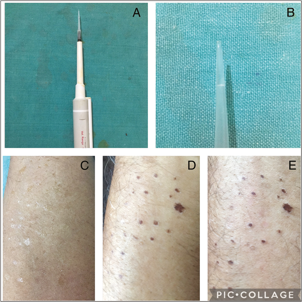 (A and B) Micropipette device having 3 µL of chemical in its tips. (C–E) The skin is precisely cauterized by touching with micropipette tips filled with trichloroacetic acid