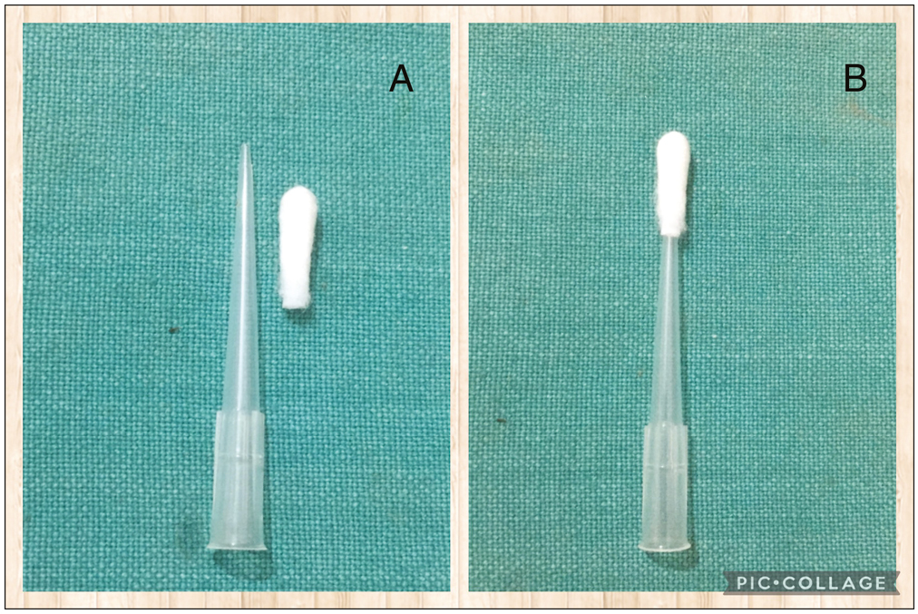 (A and B) A customized bud of plastic hollow swab stick is made to fix over micropipette tip for cautery of large lesion