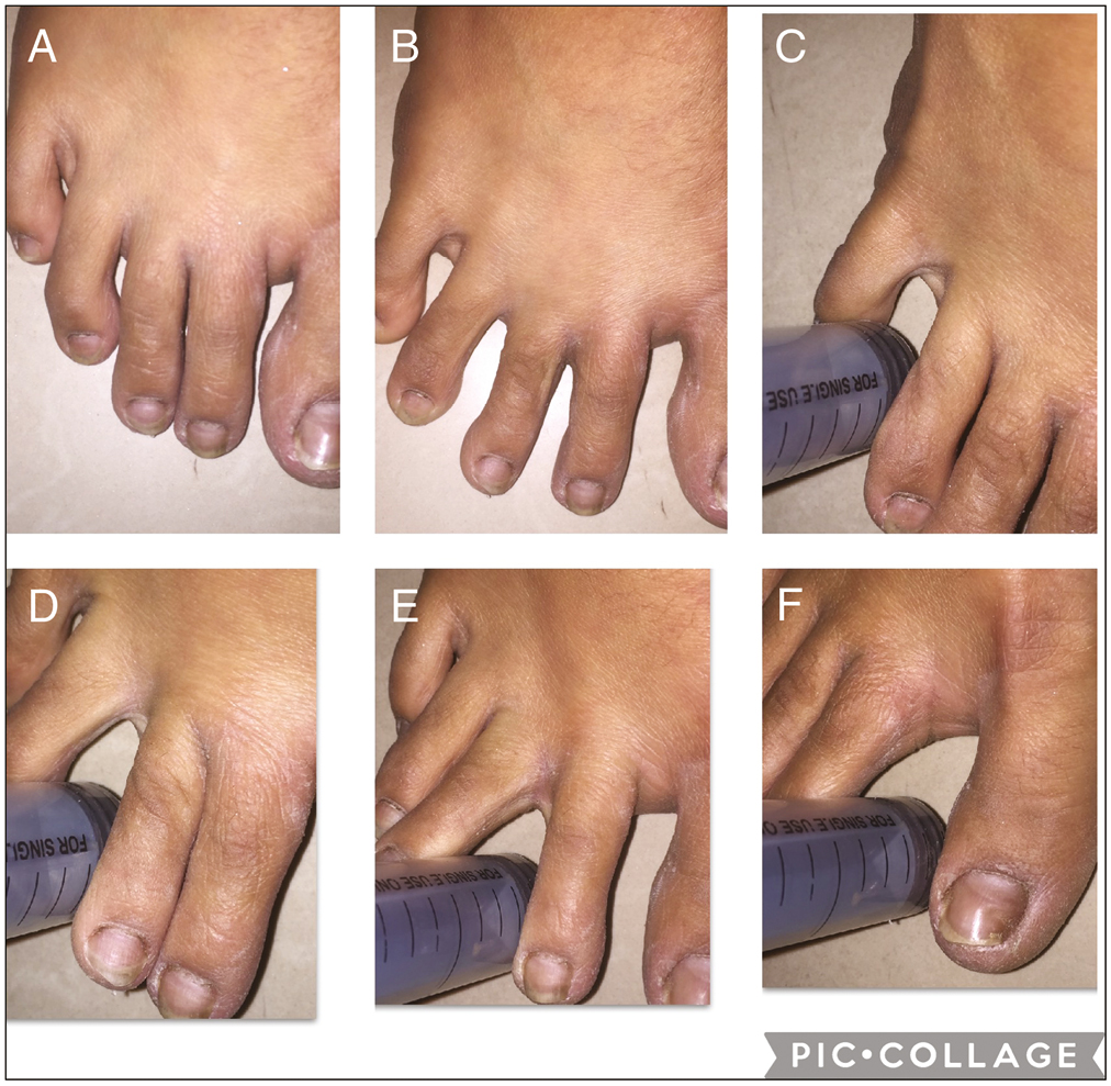 The normal interdigital space of toe in the normal state (A), abducted state (B), and interdigital space of toes after insertion of the barrel (C–F)