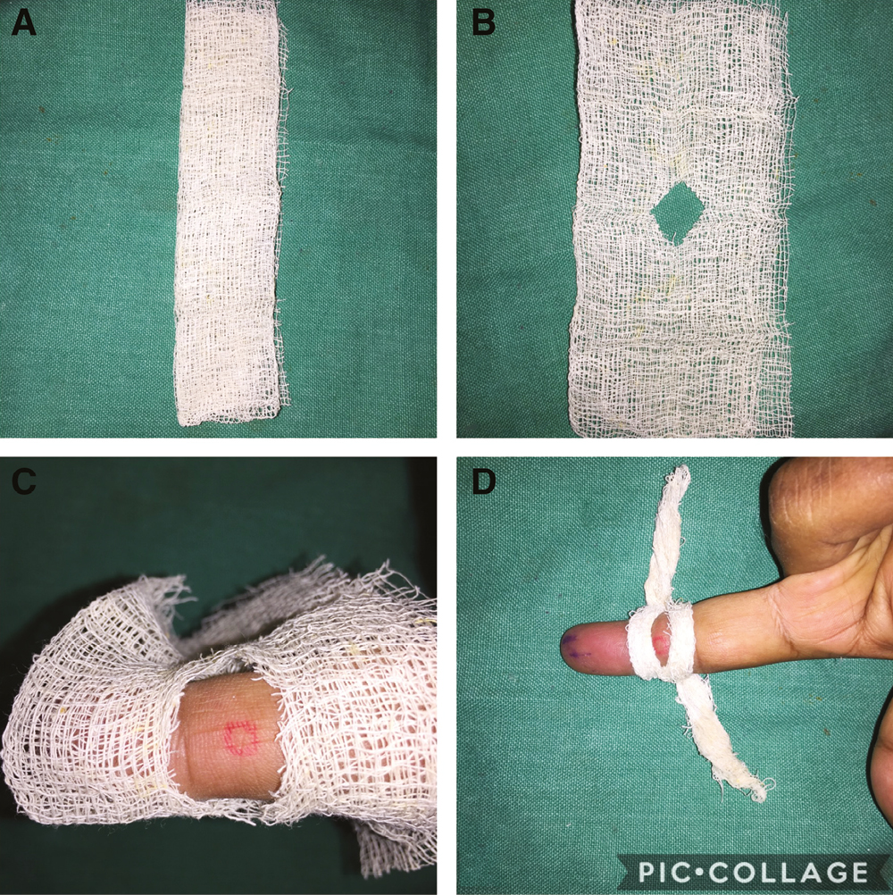 (A–D) A strip of gauze strip with a window is tied around finger