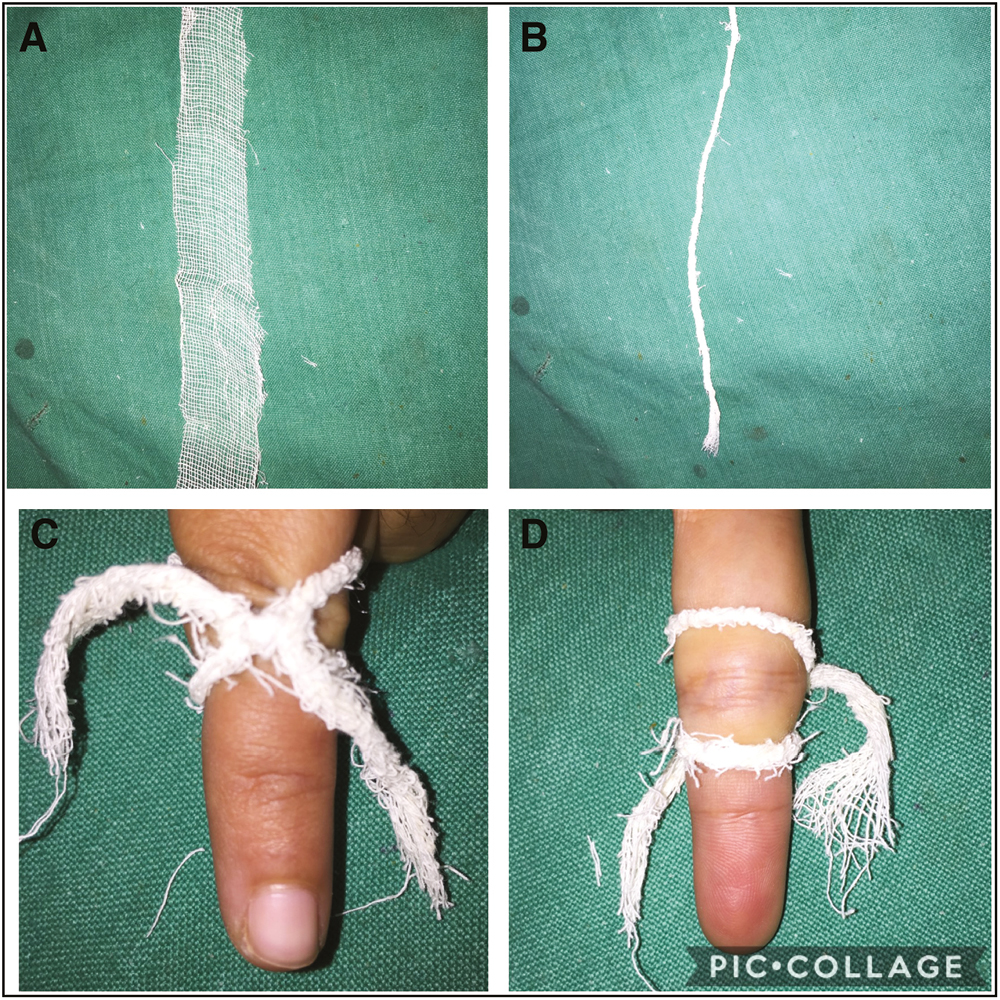 (A–D) A rope of rolled strip of gauze is tied around finger as knot 8 to trap the lesion