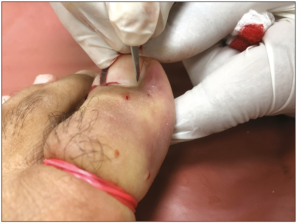 Cutting of nail plate with surgical blade applying controlled pressure toward nail matrix