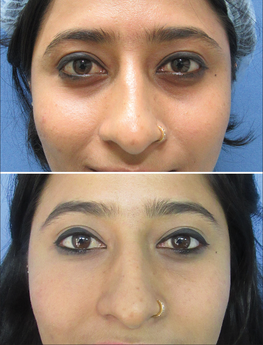 28-year-old patient with 4 cc microfat injected per side.