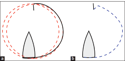 The rotation flap has a broad base so that a back cut would not pose a risk to the blood supply of the flap. Rotation would result in a slightly shorter longitudinal side of the flap so that the flap incision should be a bit eccentrical ((a) black line and (b) dashed blue line).