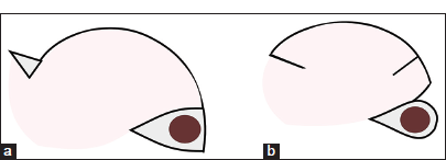 (a) Direct comparison of the classical and (b) the modified rotation flaps, (a) with Burow triangle, (b) with back-cut.