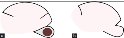 (a and b) Opening of the flap’s circumference reduces the tension along the flap margin.