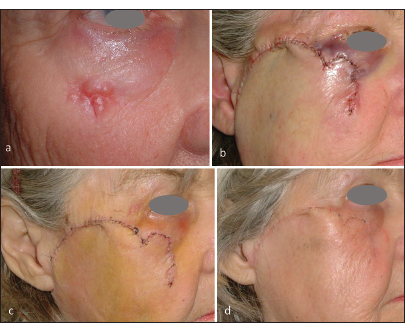 Large basal cell carcinoma of the right zygoma in an 84-year-old female patient. (a) Preoperatively. (b) End of Mohs surgery and defect repair with a modified cheek rotation flap. (c) One week after surgery, with a rotation flap with a notch. (d) Four weeks after the operation.