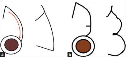 Schematic illustration of a kite or hatchet flap. (a) “Classical” design. The red arrow indicates the direction of flap movement. (b) Modified hatchet flap.