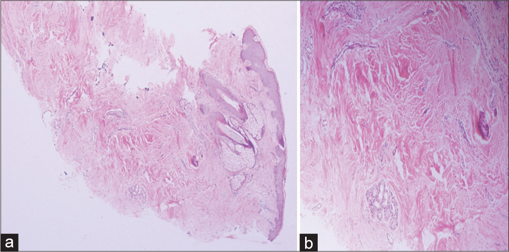 (a) Punch biopsy of the left cheek alopecia where follicular unit extraction was done. Histological slide stained in hematoxylin and eosin stains in ×22.5 magnification showing pilosebaceous glands with hair shaft and hair follicles. (b) Minimal mononuclear infiltrate was seen in the dermis with haphazardly arranged collagen bundles suggesting an old scar.