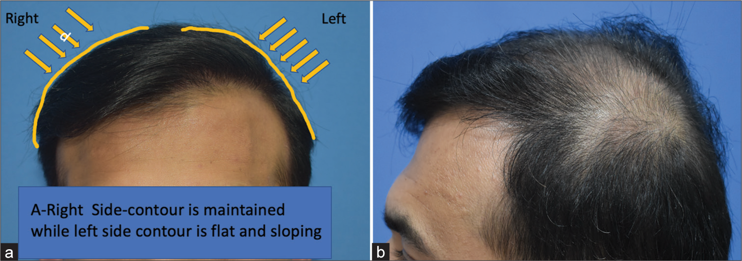 Results after 11 months of hair transplant, whose (a) front and (b) mid-scalp were transplanted, now showing loss of contour on his left side and thinning in the parietal area and part line.