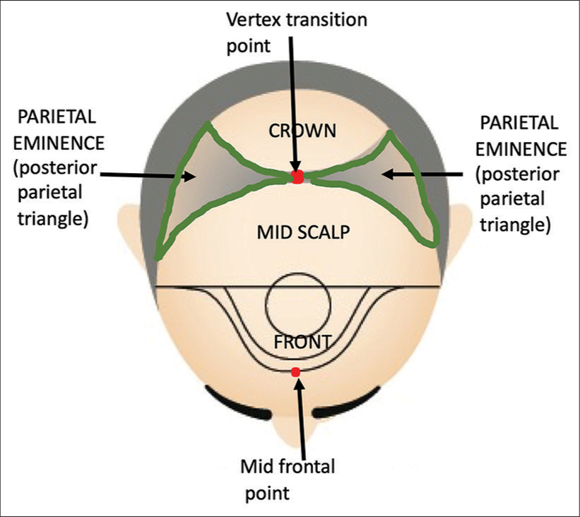 Scalp major zones and posterior parietal triangles or parietal eminence areas.