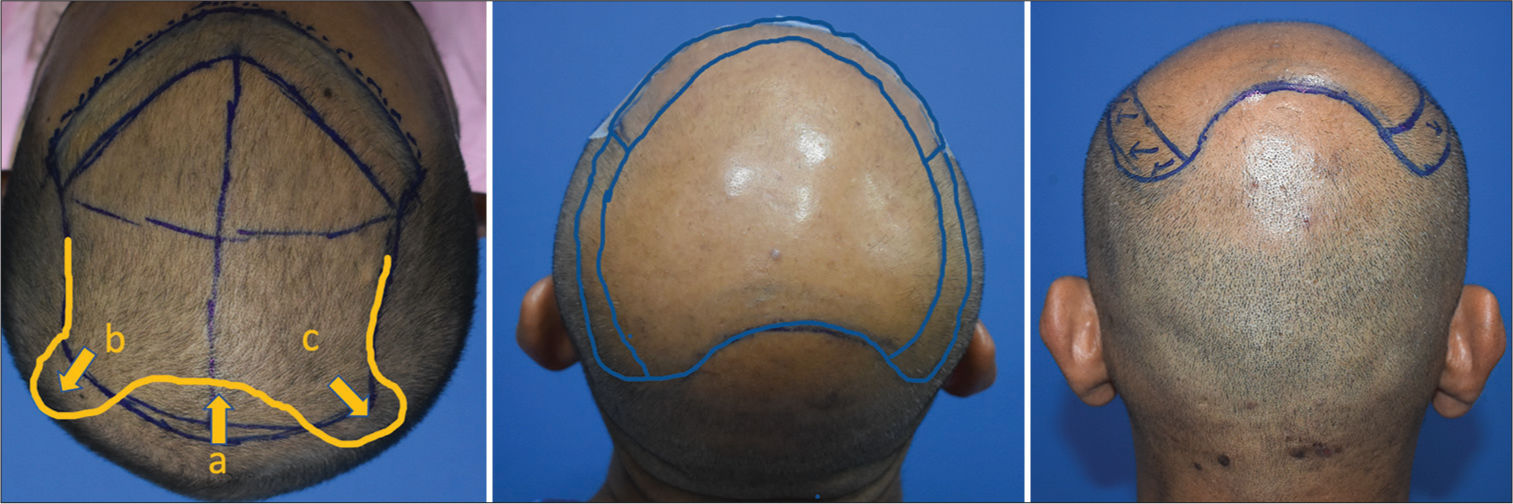 Modification to cover posterior parietal area by extending posteriorly laterally in areas “b” and “c.” The final area looks like a heart shape.