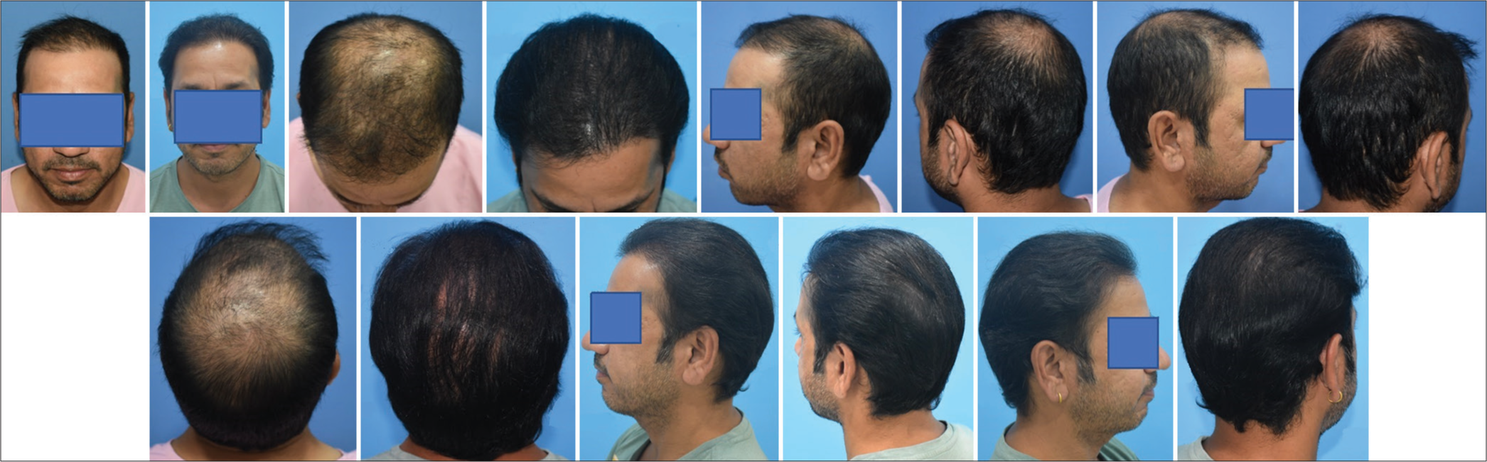 This young man had hair loss and thinning in the front, mid-scalp and crown. A total of 5256 grafts were implanted in two days. On day one, three thousand thirty grafts were harvested from the scalp and 2226 grafts from the beard on the second day. Front, mid-scalp, including parietal eminence (posterior parietal triangle), were transplanted. After eight months of hair transplant, the results showed good coverage over parietal eminence.