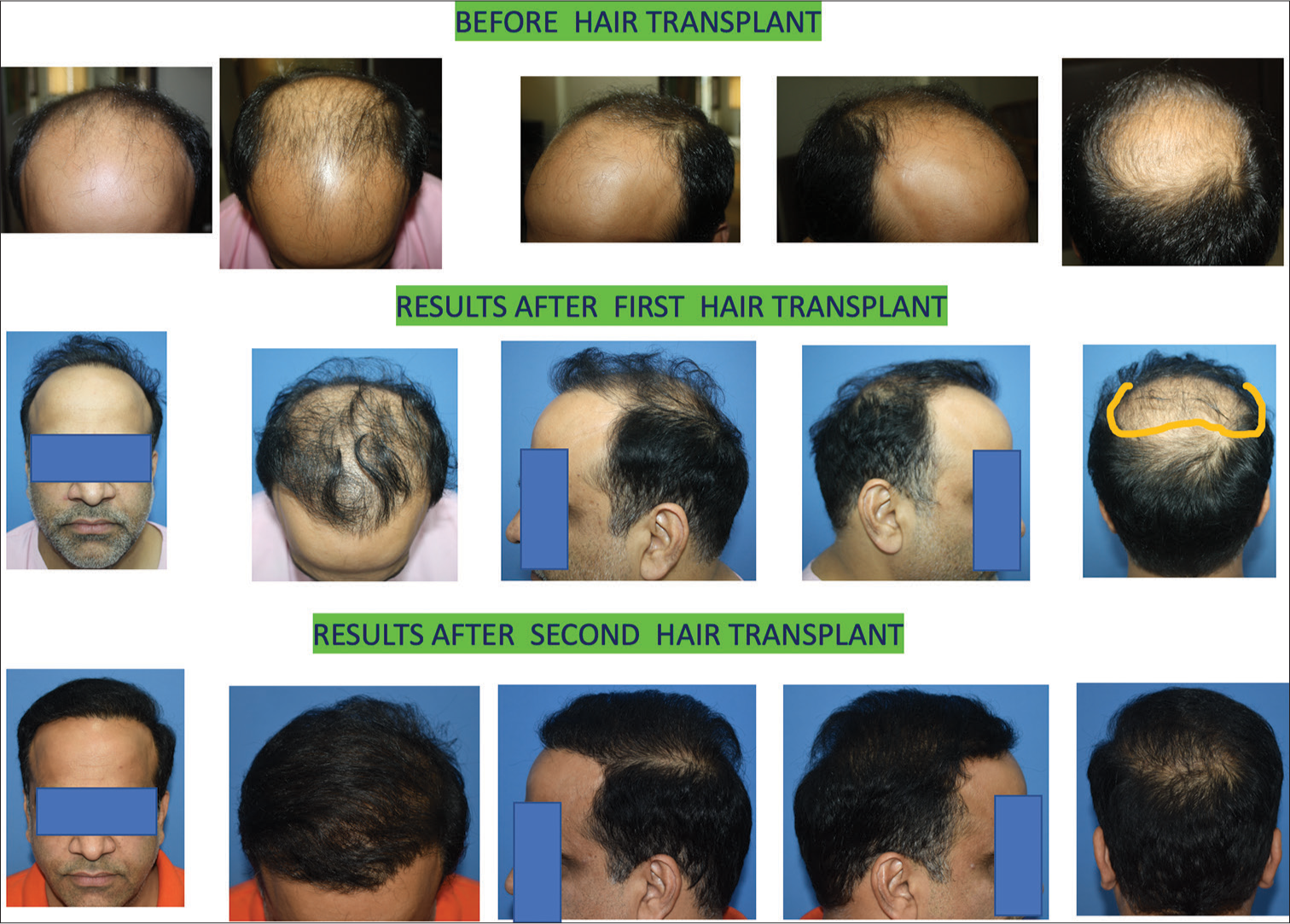 This young man Norwood grade VII. Follicular unit transplantation (FUT) was done. A total of 3506 grafts were implanted. After six years of primary hair transplant, a total of 4550 grafts were harvested, 2526 from the scalp by follicular unit extraction (FUE) and 2024 from the beard. The anterior hairline was revised, and mid-scalp and upper crown, including side parietal eminence areas, were transplanted. After ten months of hair transplant, the results showed good coverage, except lower crown area.