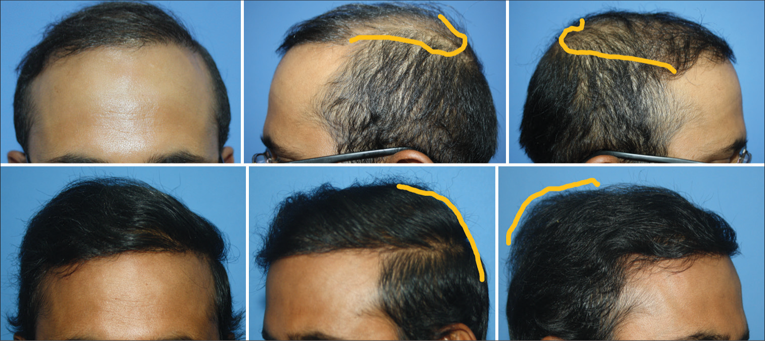 This young man had Norwood grade VI baldness. Some surgeons implanted approximately 2500 follicular unit transplantation (FUT) grafts. However, the patient was concerned about thinning in the part line and parietal eminence area, which were quite noticeable in oblique and lateral profile. We implanted 5023 grafts from the scalp and beard, covering the parietal area and part of the crown. The results are after 13 months of hair transplant.