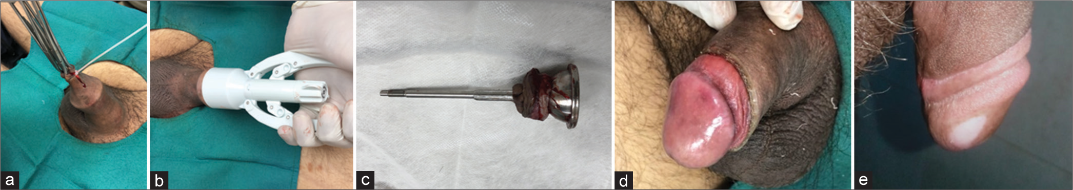 (a) Clamping of foreskin after creating a dorsal slit (b) An outer bell is inserted and the trigger is pushed to perform cutting of excess foreskin, (c) Excess foreskin removed, (d) Post-circumcision appearance of penis, and (e) Appearance of penis two months post procedure.