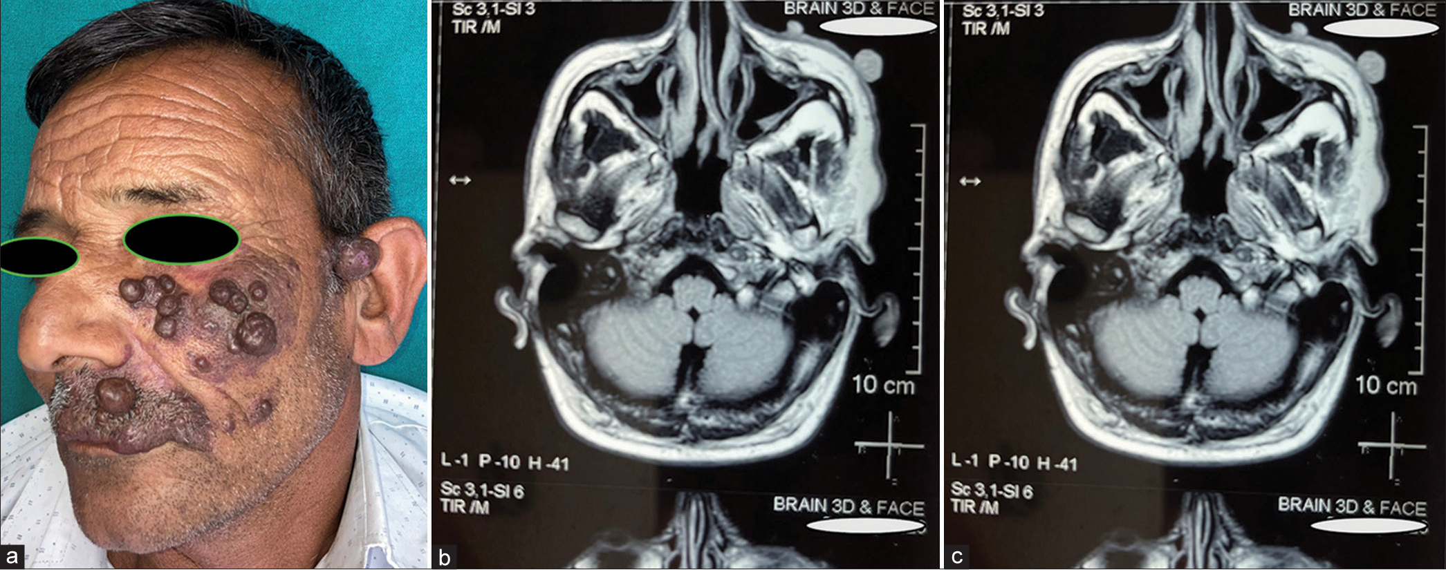 (a) Multiple reddish-purple nodules occupying the left side of the face in a patient with port-wine stains (PWS). (b) High-power view of PWS showing dilated superficial dermal blood vessels and endothelial proliferation along with fibro-collagenous tissue with intervening adnexal structures (hematoxylin and eosin ×400). (c) Magnetic resonance imaging showing multiple skin-based nodular lesions with exophytic components (T1 weighted).