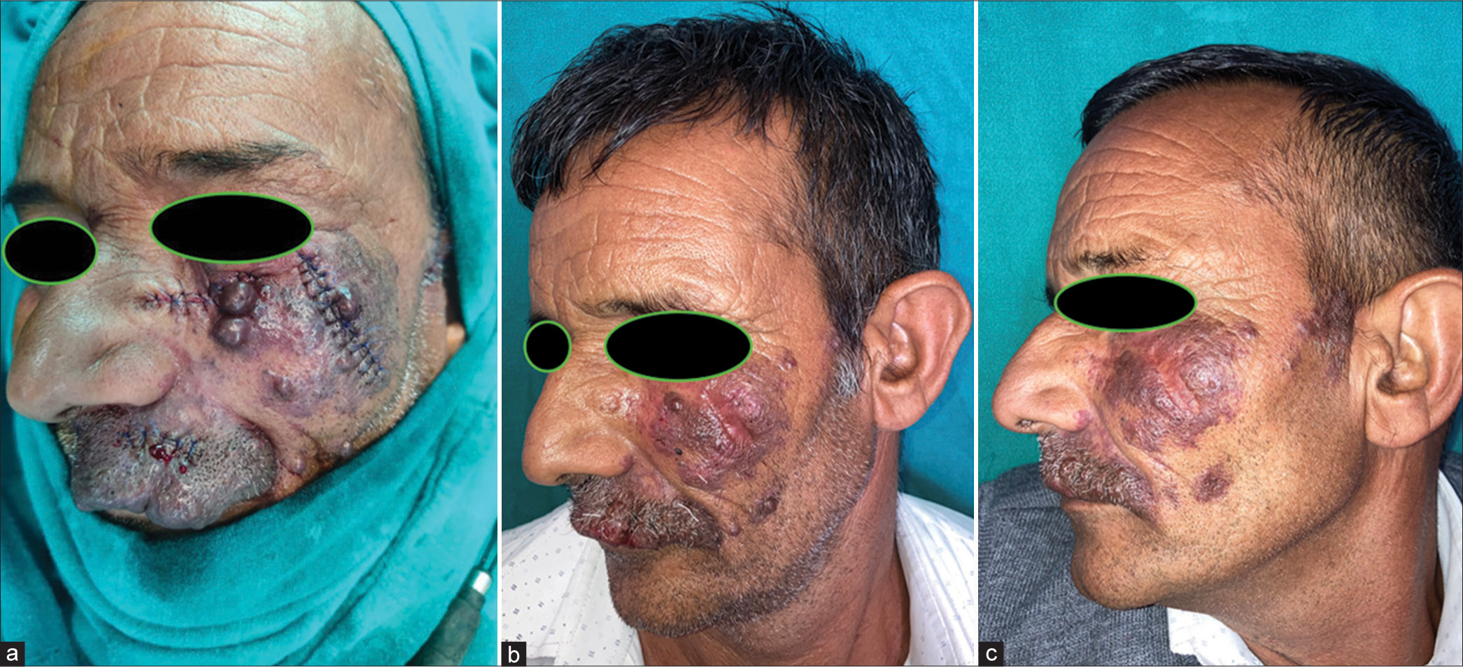 (a) Intraoperative picture during first stage surgical resection after removal of nodular lesions from the molar and zygomatic region. (b) At 1 month follow-up, showing improvement in facial symmetry and visual field. At this stage, radiofrequency ablation was deployed to remove smaller lesions. (c) At the 6-month follow-up showing improved facial symmetry and topography with no evidence or recurrence of nodules/hypertrophy.