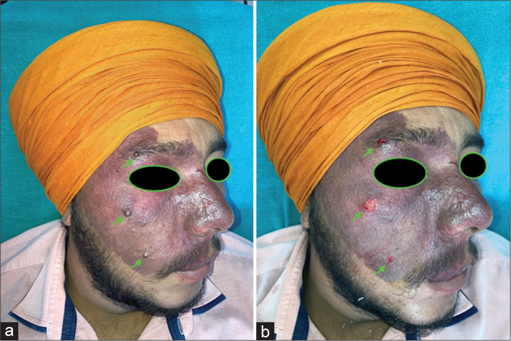 (a) Single erythematous patch of size 15 cm × 10 cm with multiple embedded papules along with three discrete subcentimetric nodularities (arrows). (b) After radio frequency ablation deployment at the three nodular lesions, showing achievement of hemostasis (arrows).