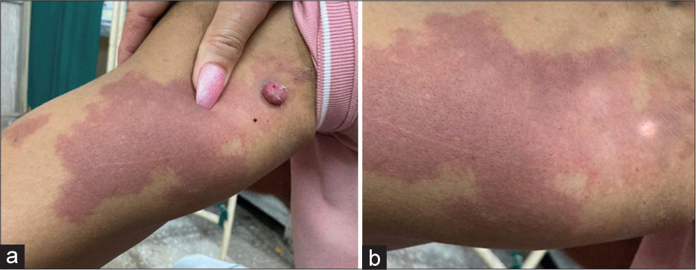 (a) A bright red patch measuring 12 cm × 8 cm on the posterolateral aspect of the upper left arm with an inflamed pedunculated polyp of 2 cm diameter. (b) At 1 month follow-up, showing no sign of recurrence.